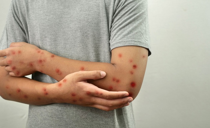 Mpox volta a preocupar EUA